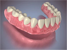 conventional denture