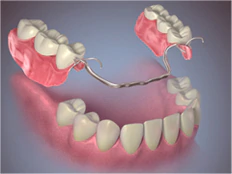 conventional denture